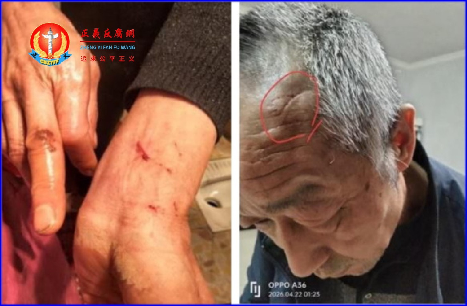 湖北宜城市板桥店镇商贩余善强因进京反映司法不公，被当地政府官员和公安机关截返，途中遭到殴打至多处受伤。.jpg